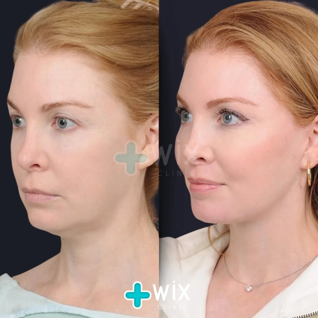 Facelift before and after