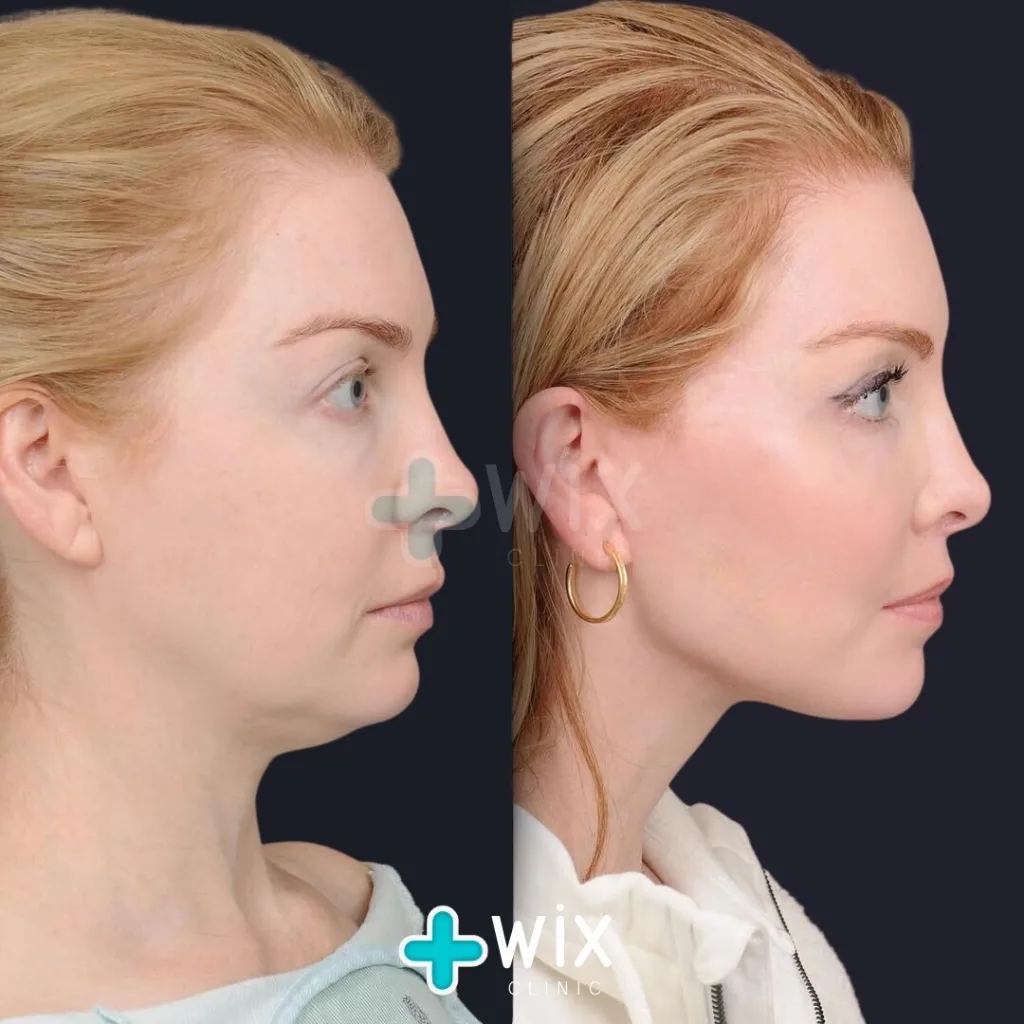 Facelift before and after