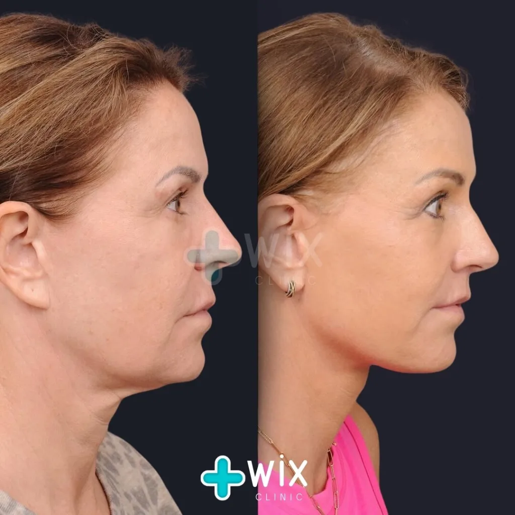 Mini Facelift before and after