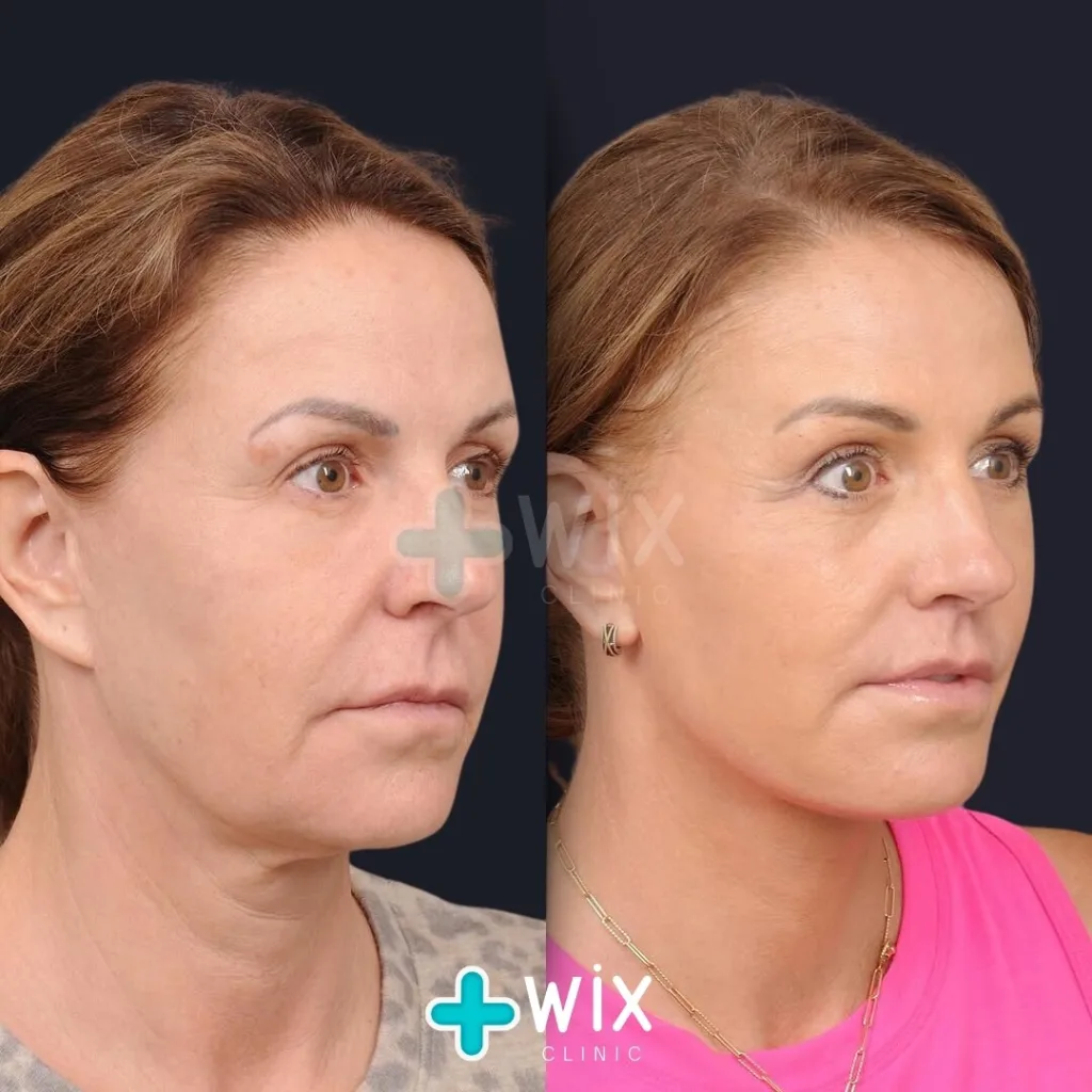 Mini Facelift before and after