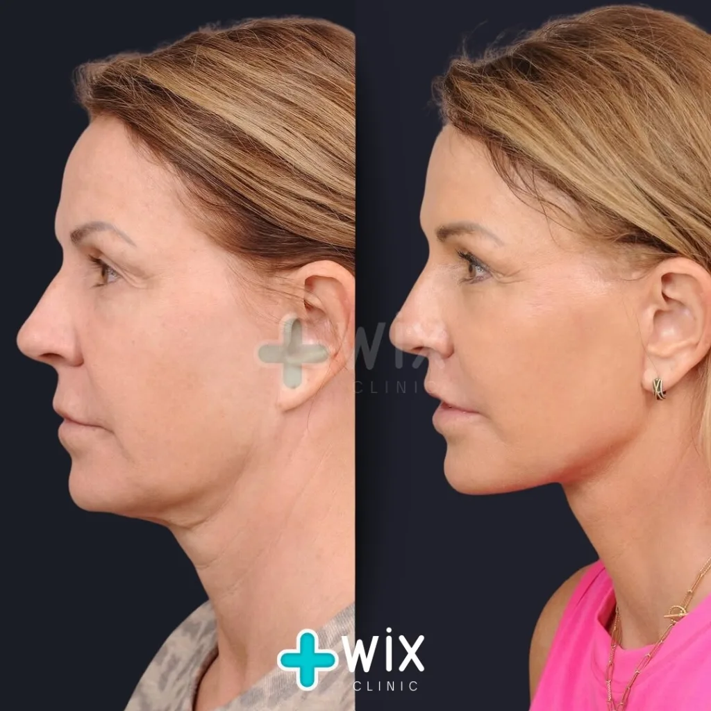 Mini Facelift before and after