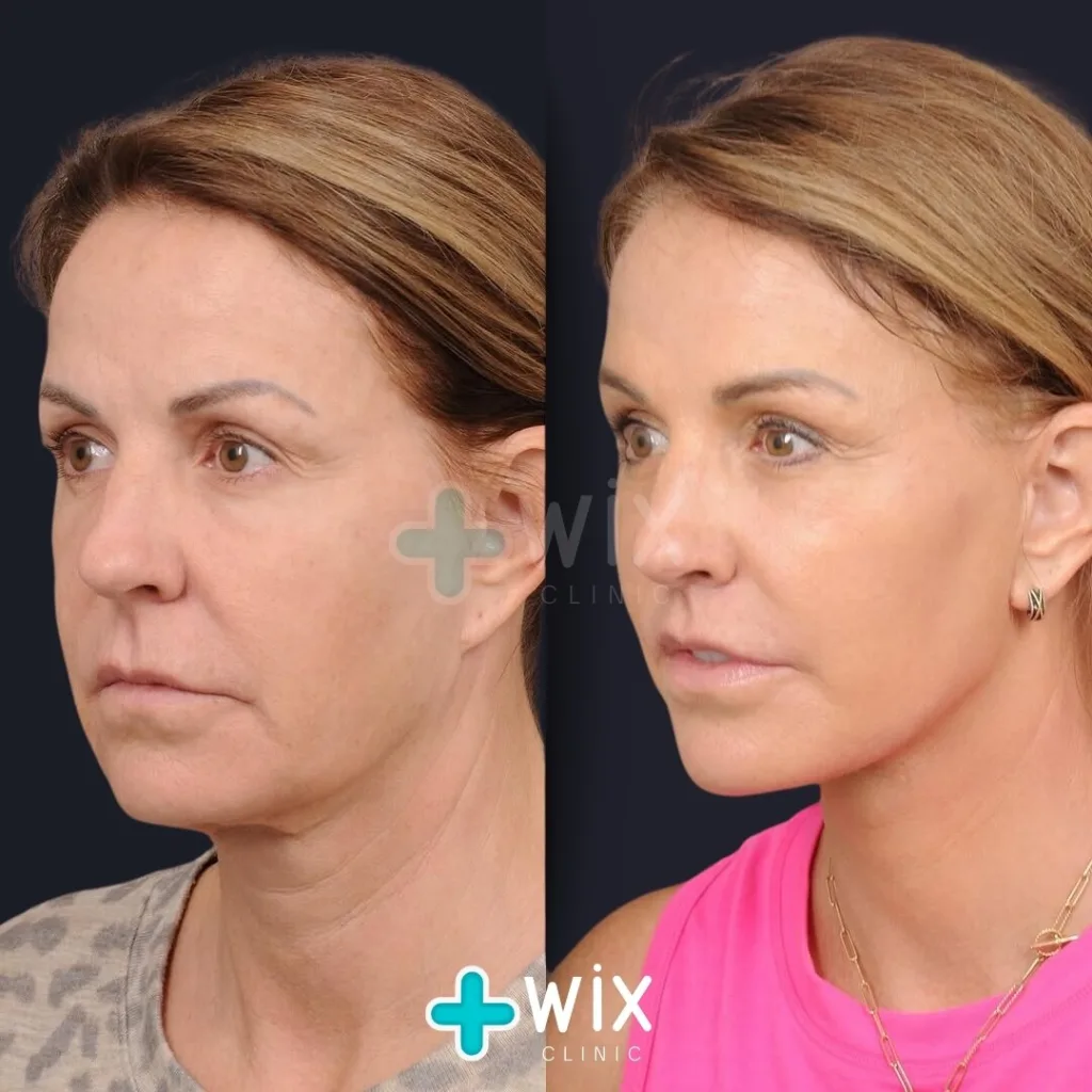 Mini Facelift before and after