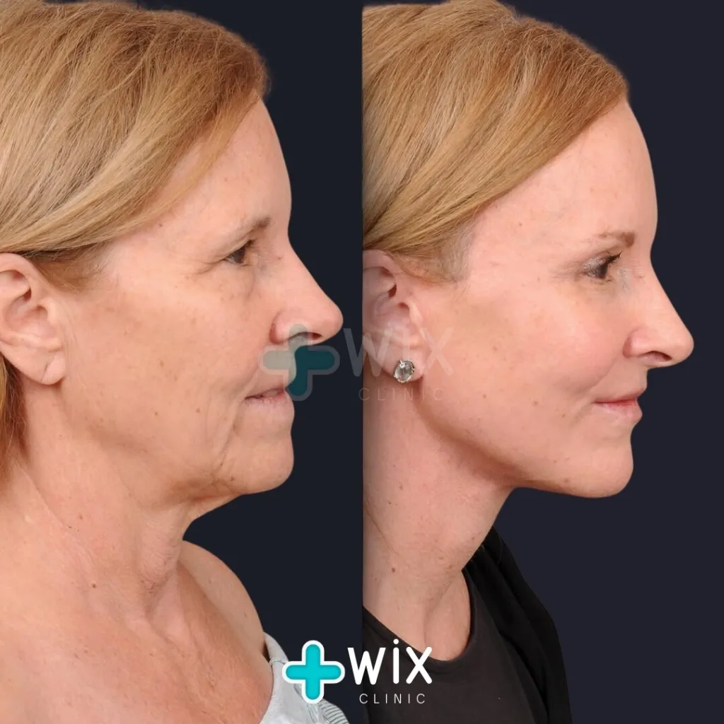 Facelift before and after