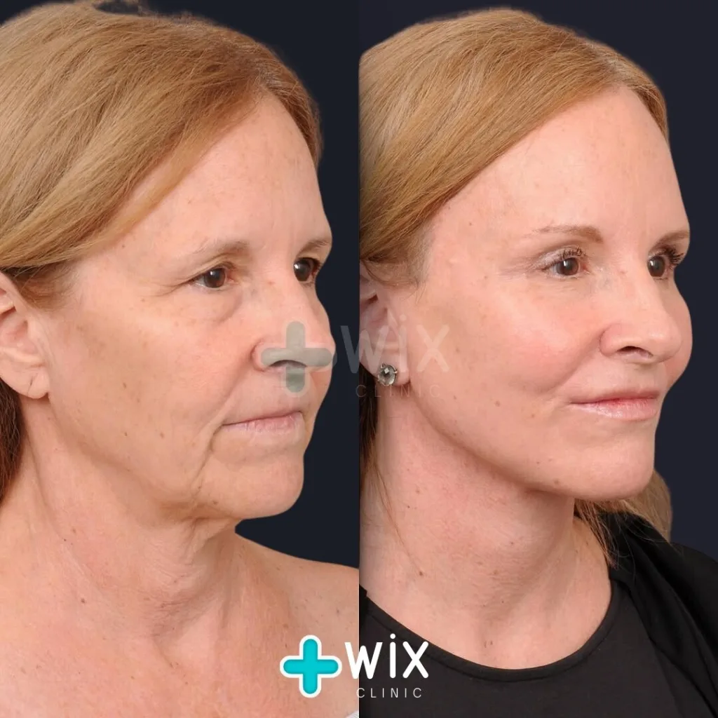 Facelift before and after