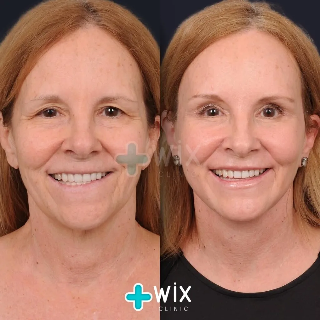 Facelift before and after