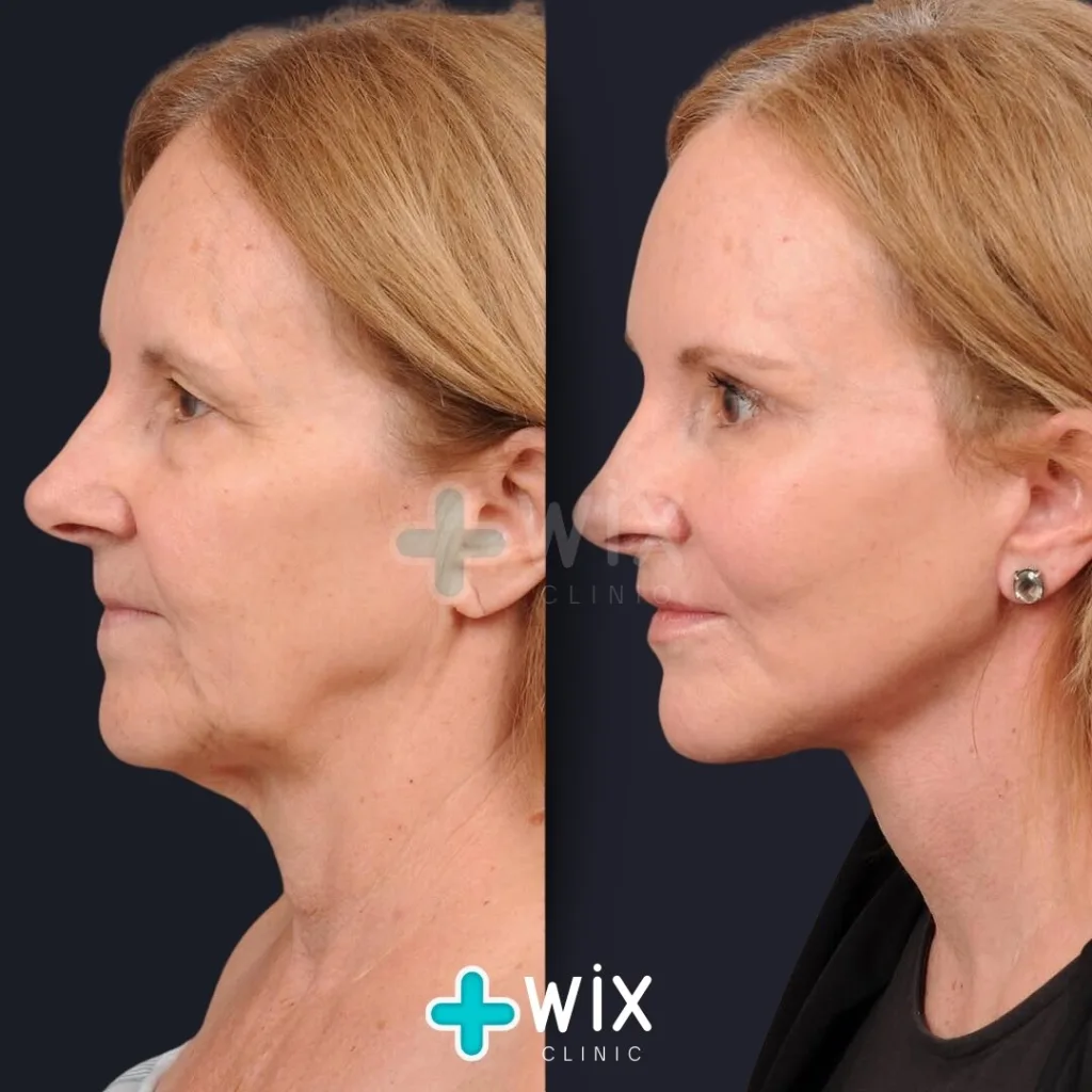 Facelift before and after