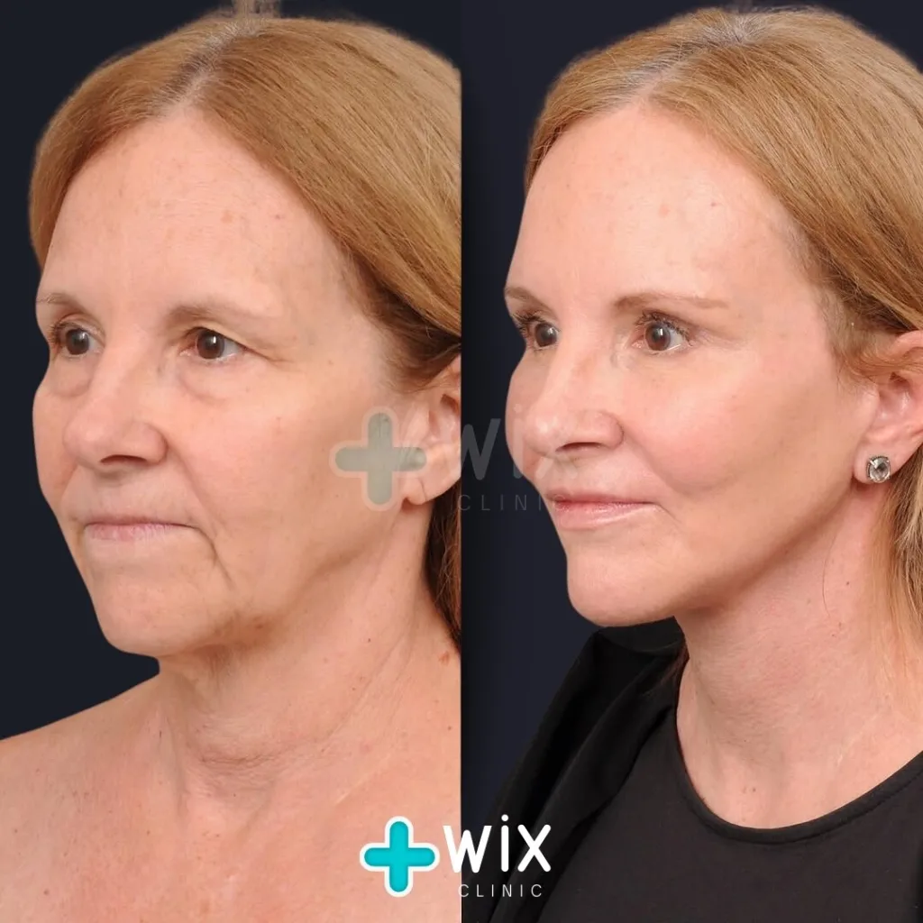 Facelift before and after