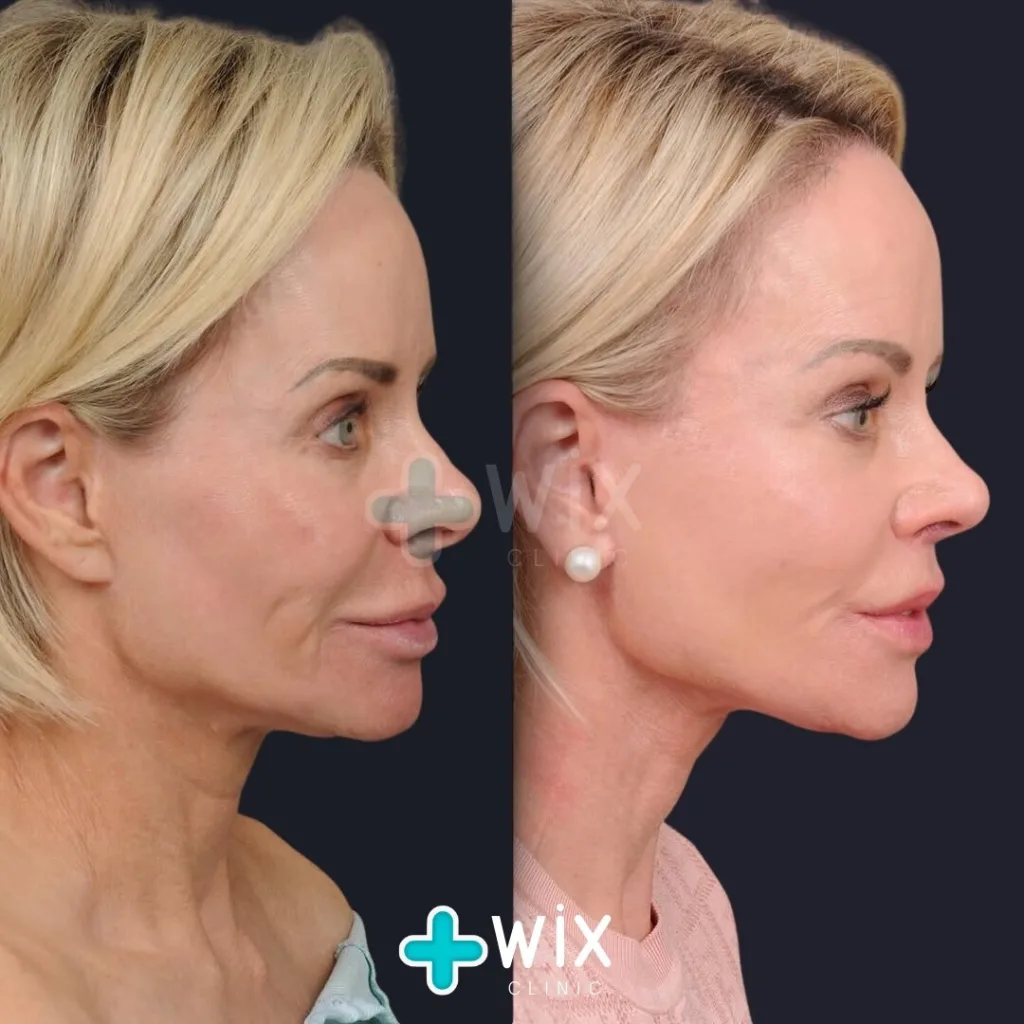 Facelift before and after