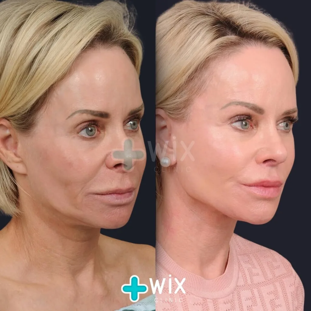 Facelift before and after