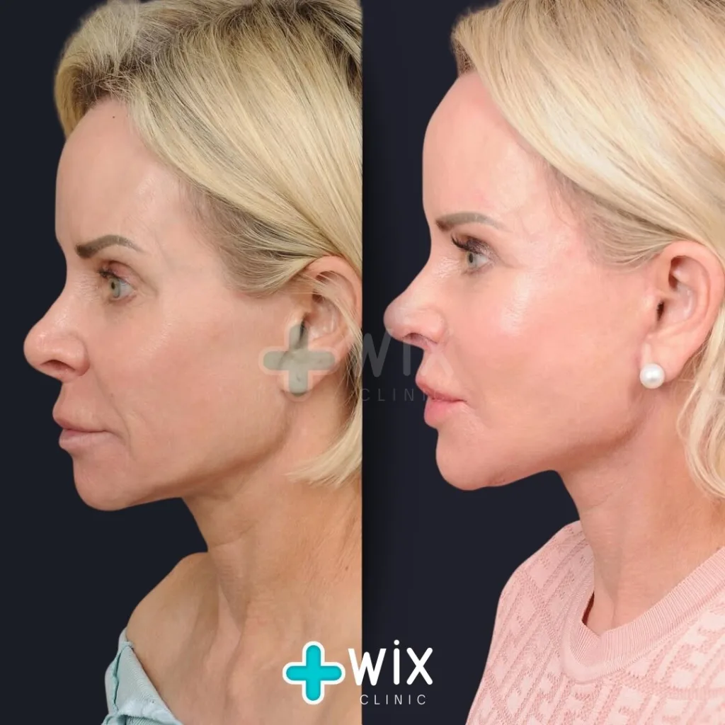 Facelift before and after