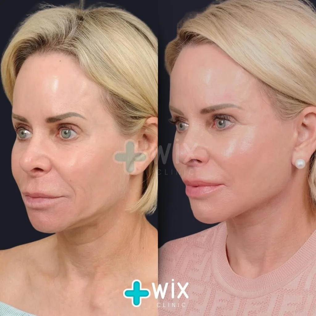 Facelift before and after