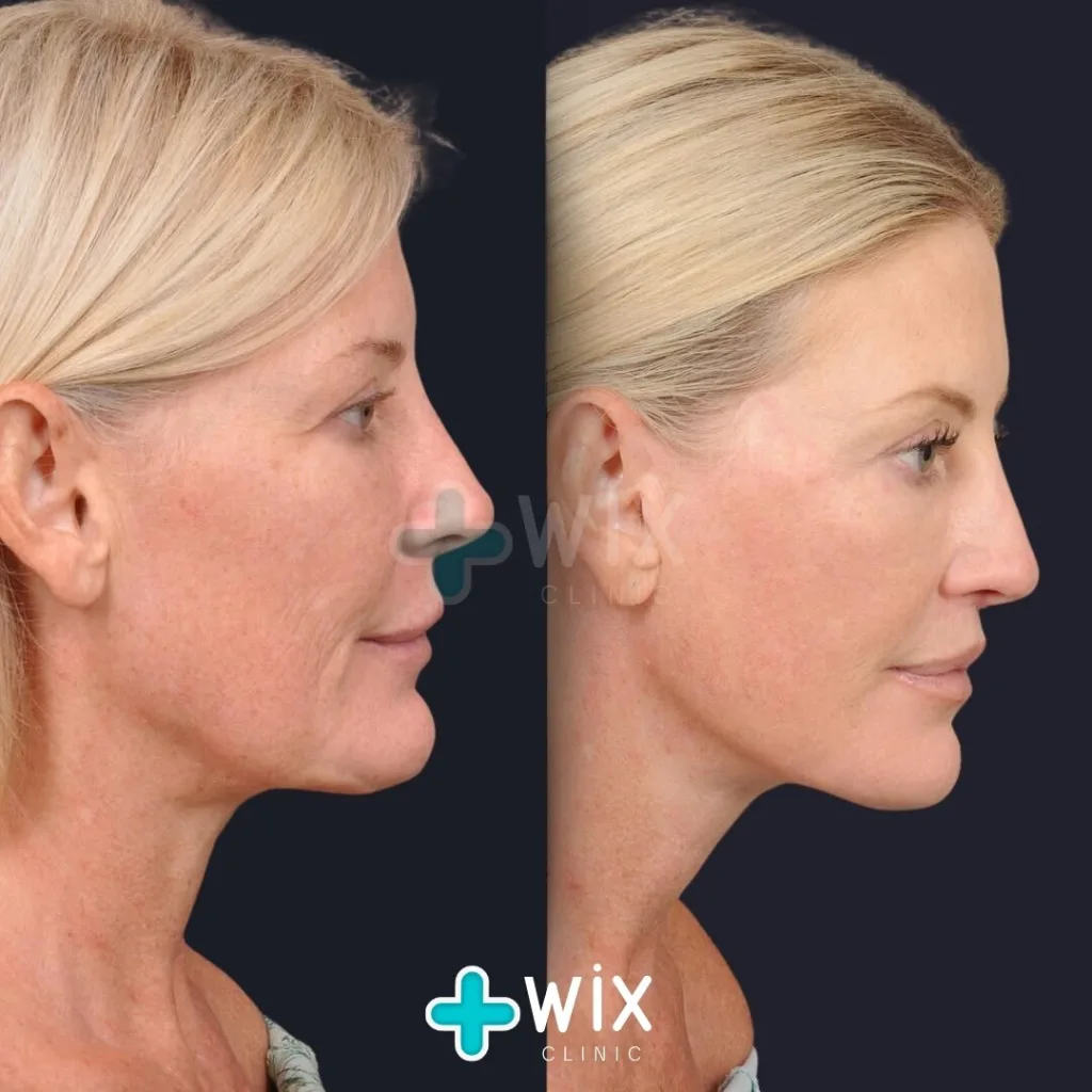 Facelift before and after