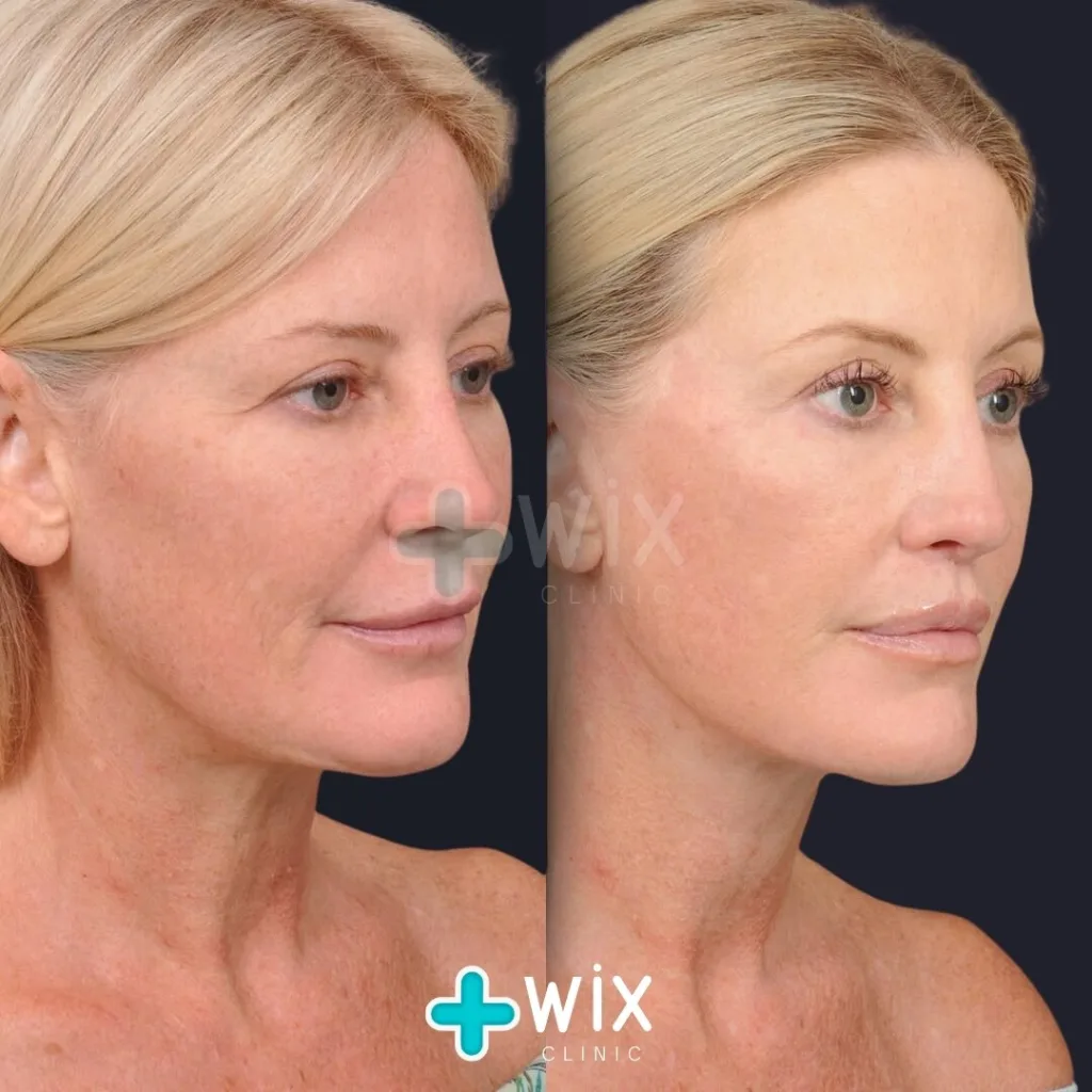 Facelift before and after