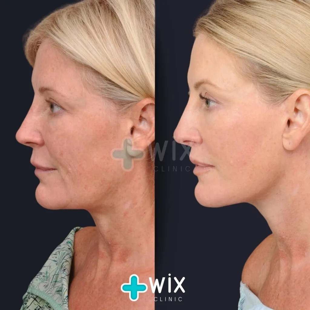 Facelift before and after