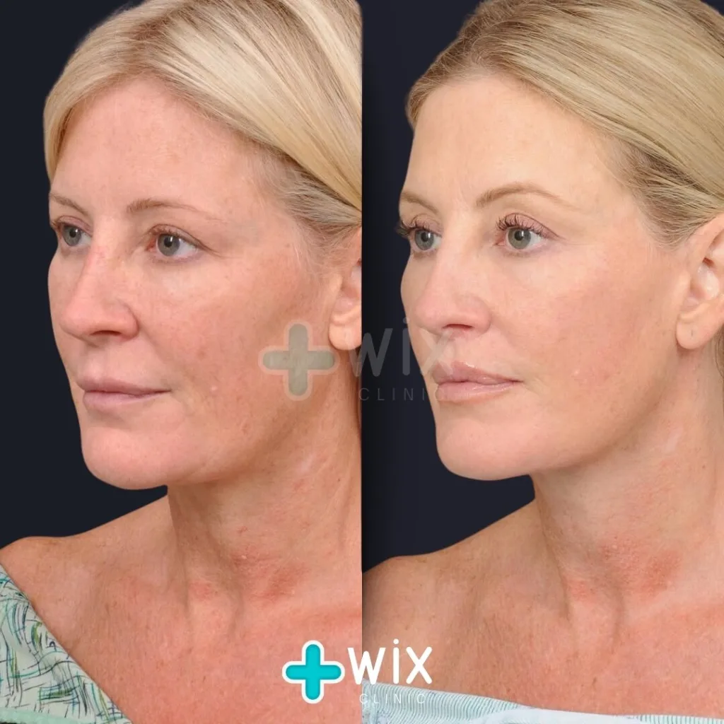 Facelift before and after