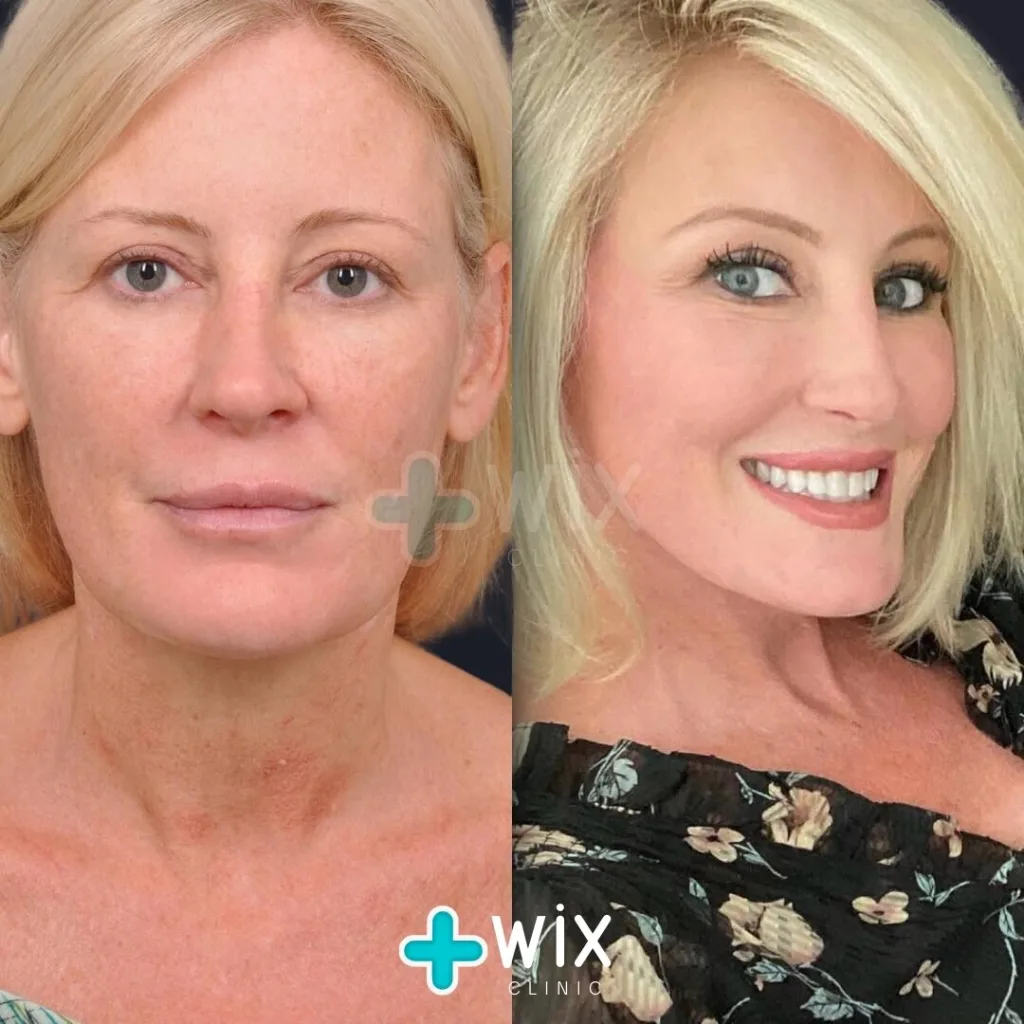 Facelift before and after