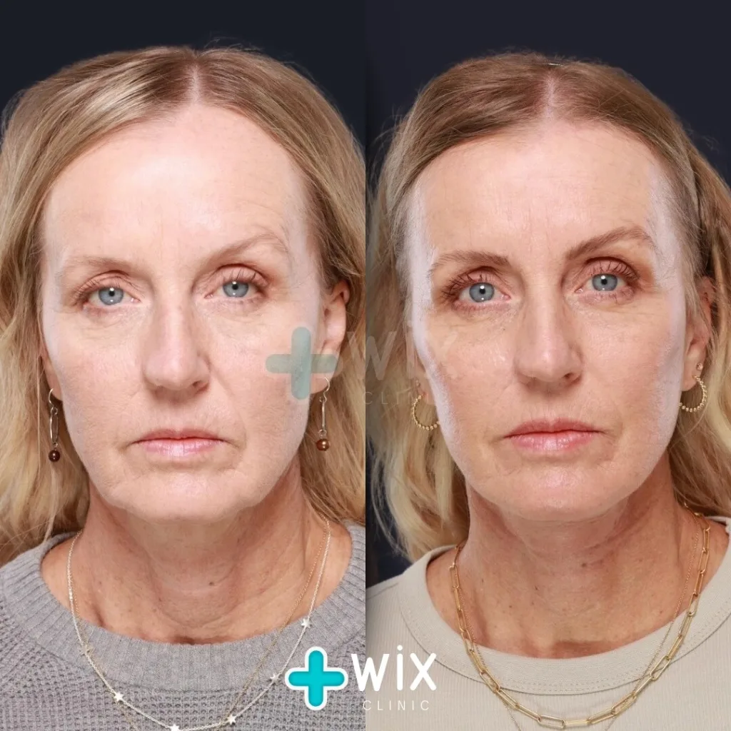 Facelift before and after