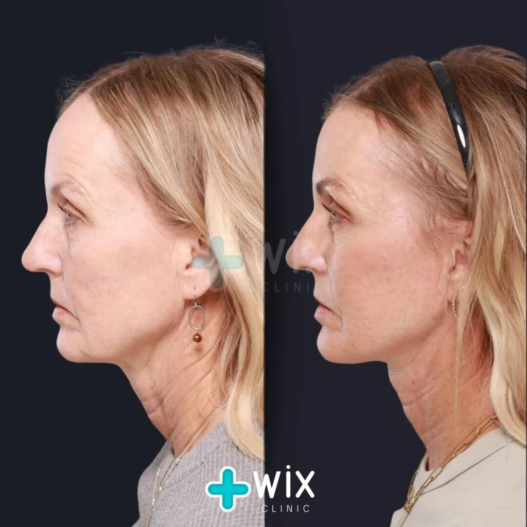 Facelift before and after