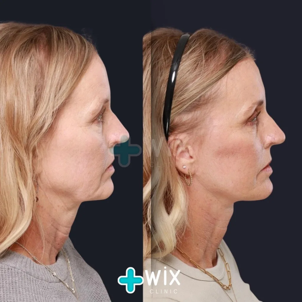 Facelift before and after