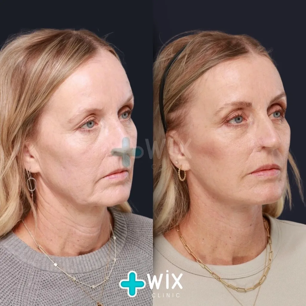 Facelift before and after