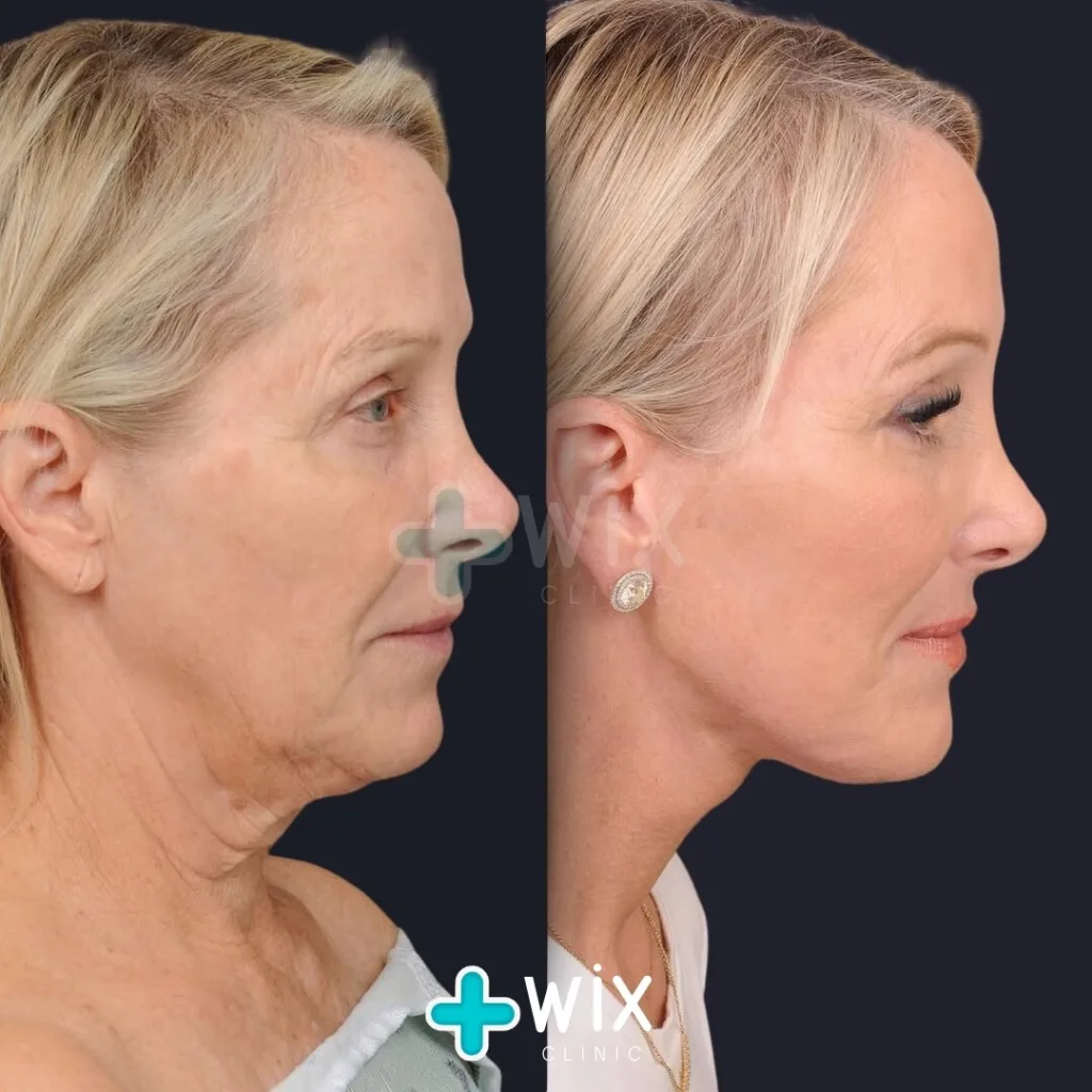 Facelift before and after