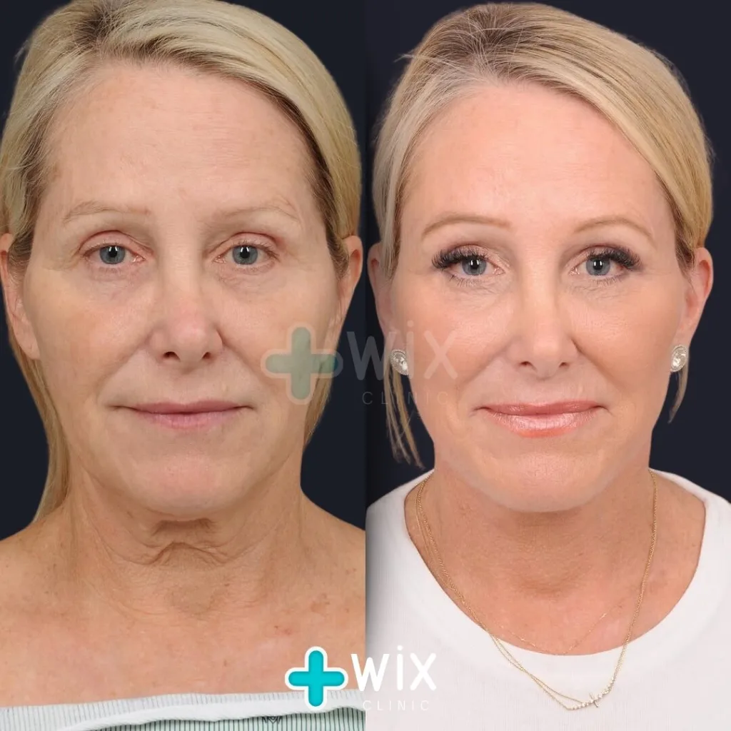 Facelift before and after