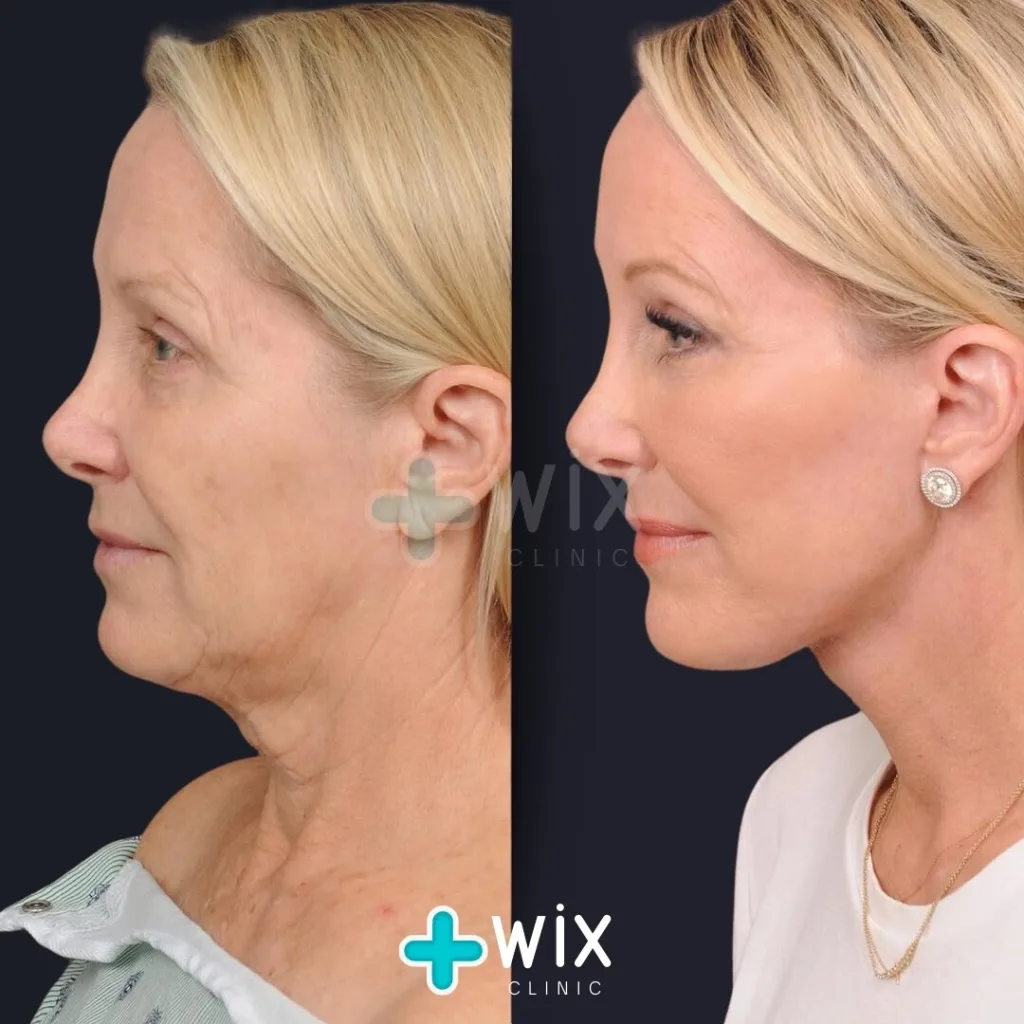 Facelift before and after