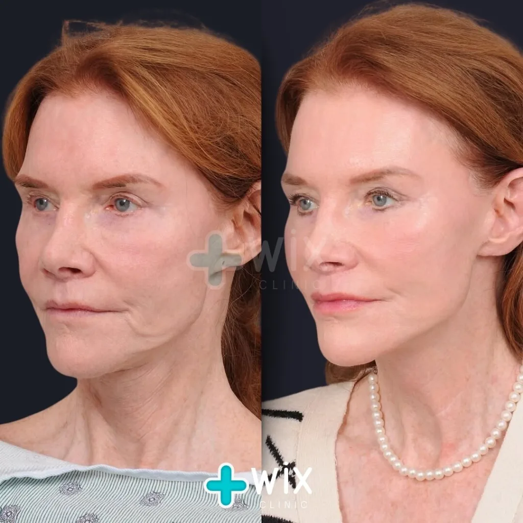 Mini facelift before and after