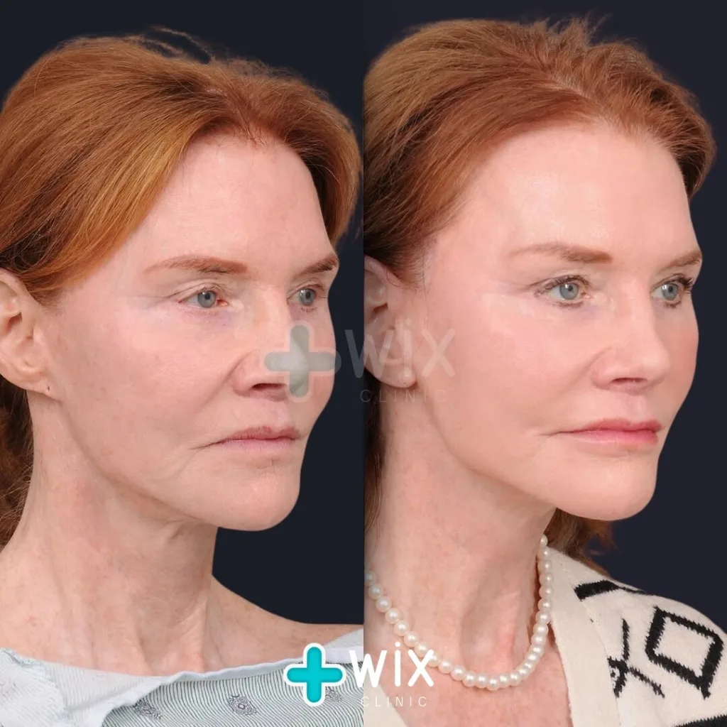 Mini facelift before and after