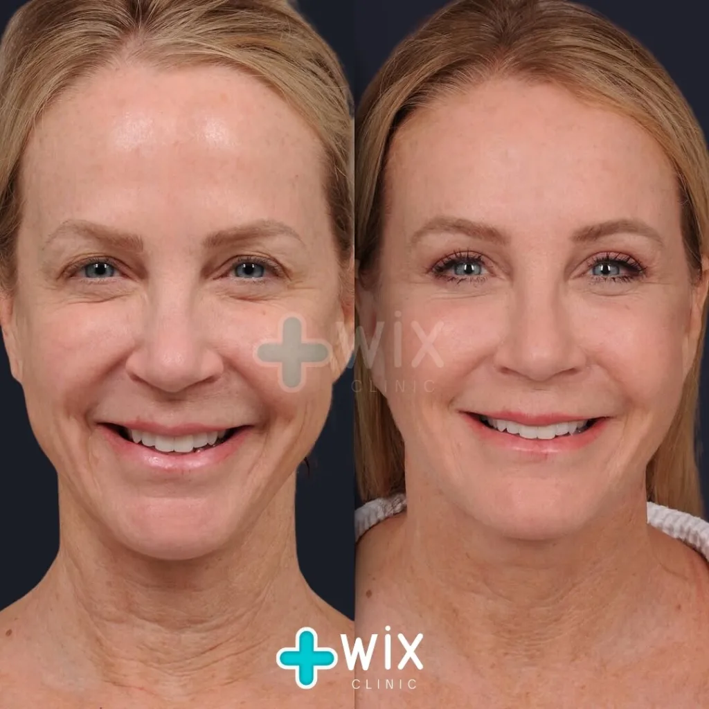 Facelift before and after