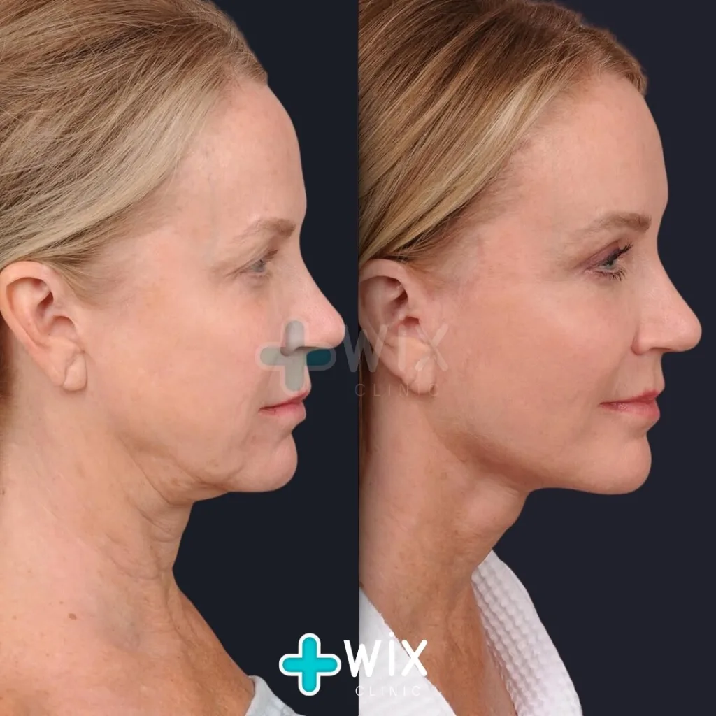 Facelift before and after