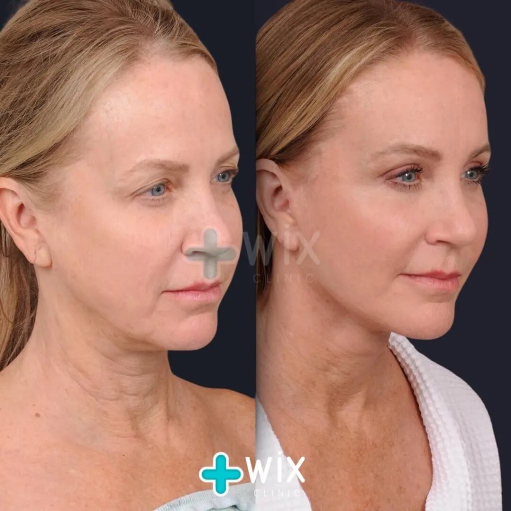 Facelift before and after