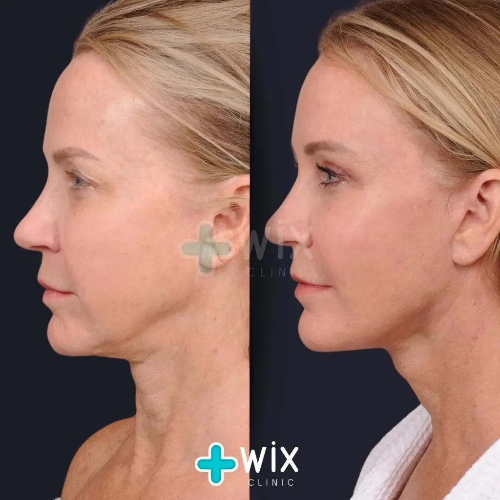 Facelift before and after