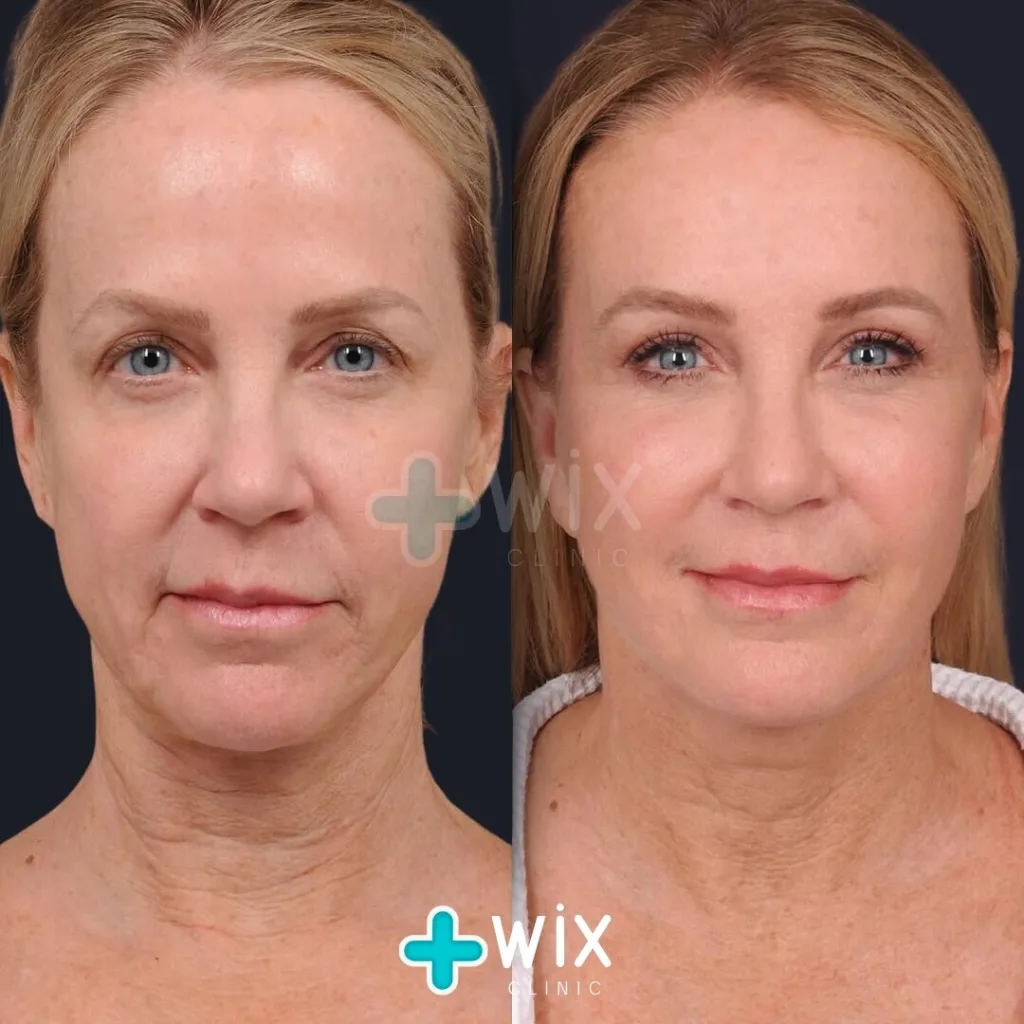 Facelift before and after