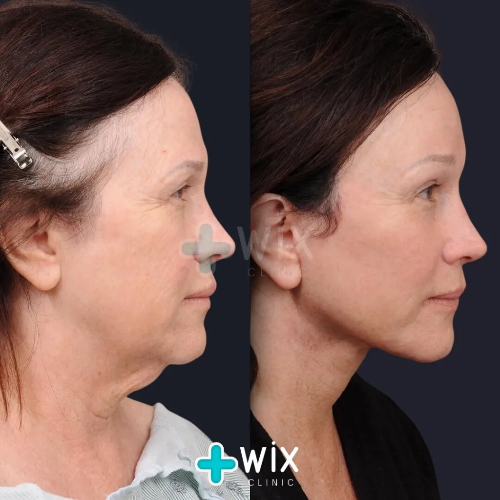 Facelift before and after