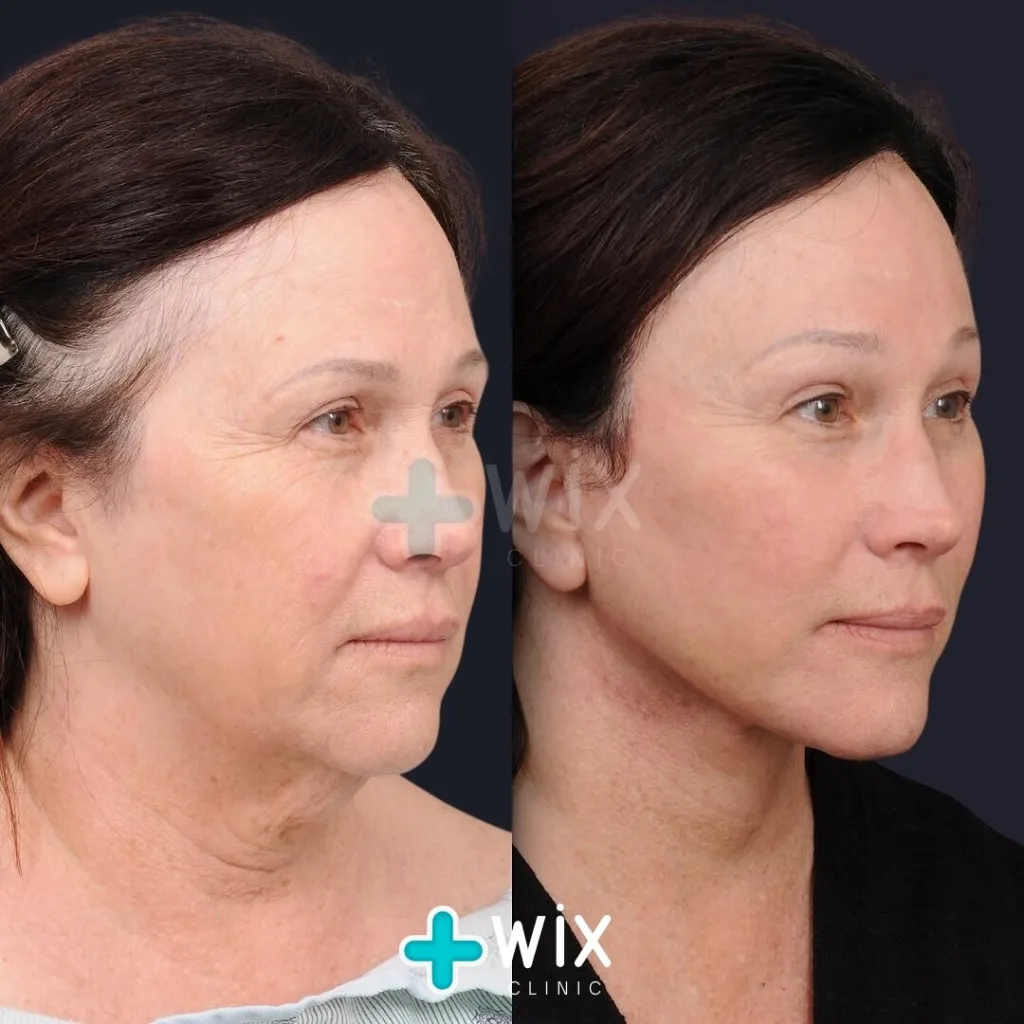 Facelift before and after