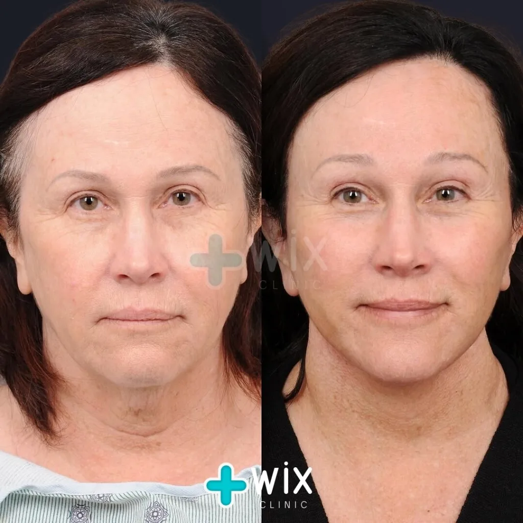 Facelift before and after