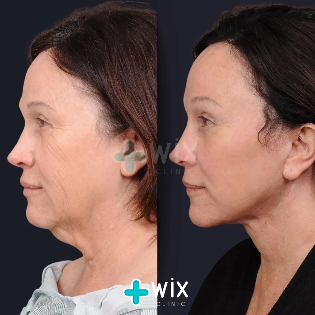 Facelift before and after