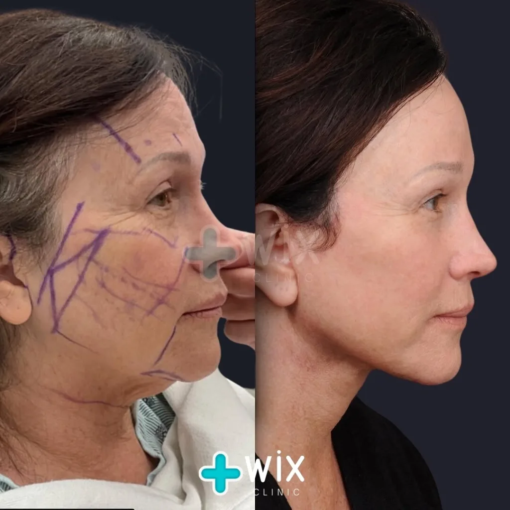 Facelift before and after