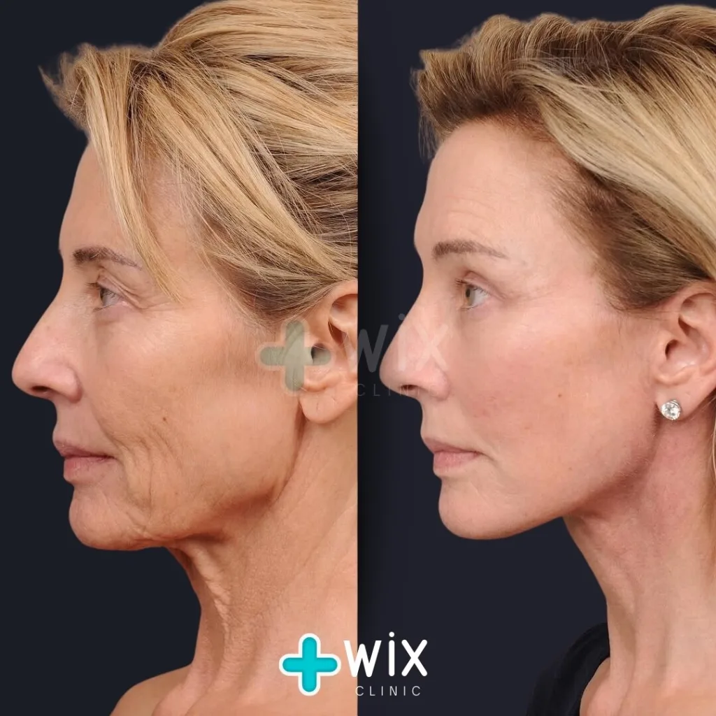 mini facelift before and after