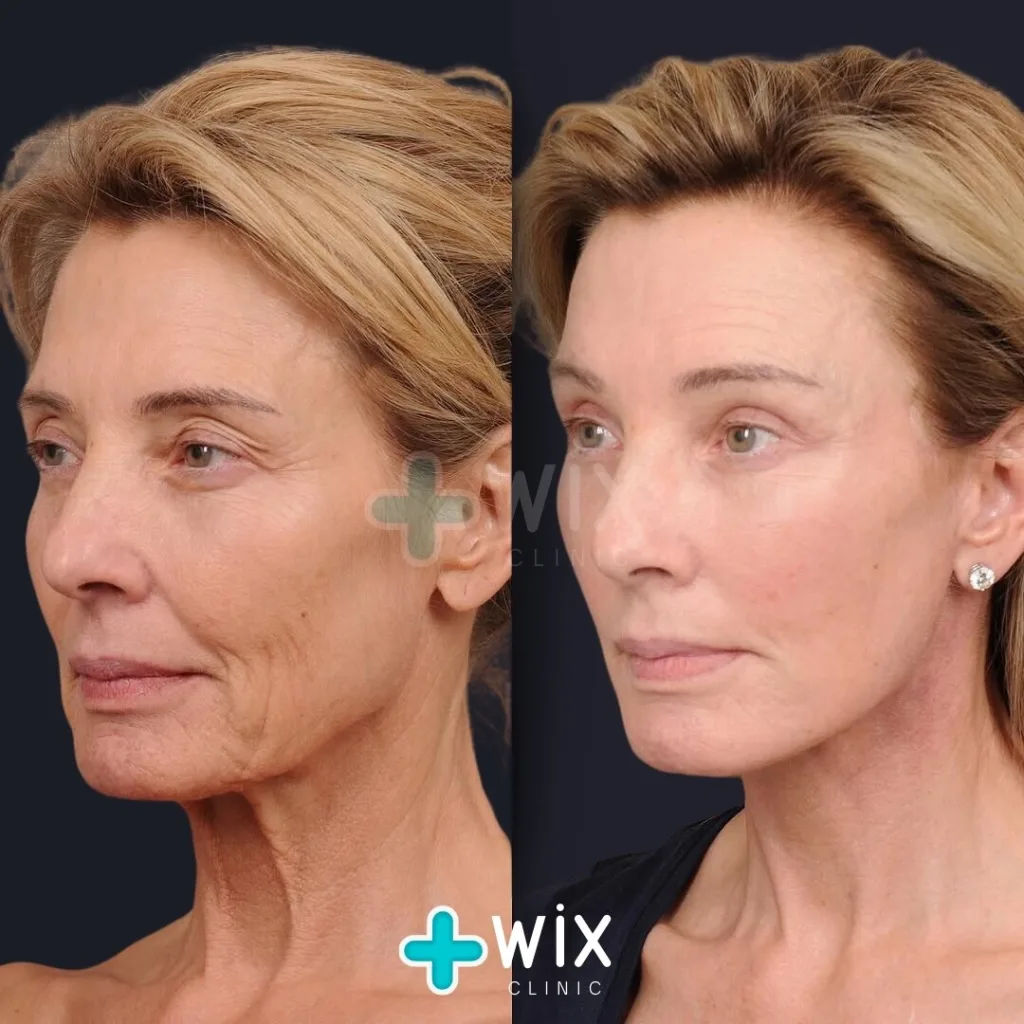 mini facelift before and after