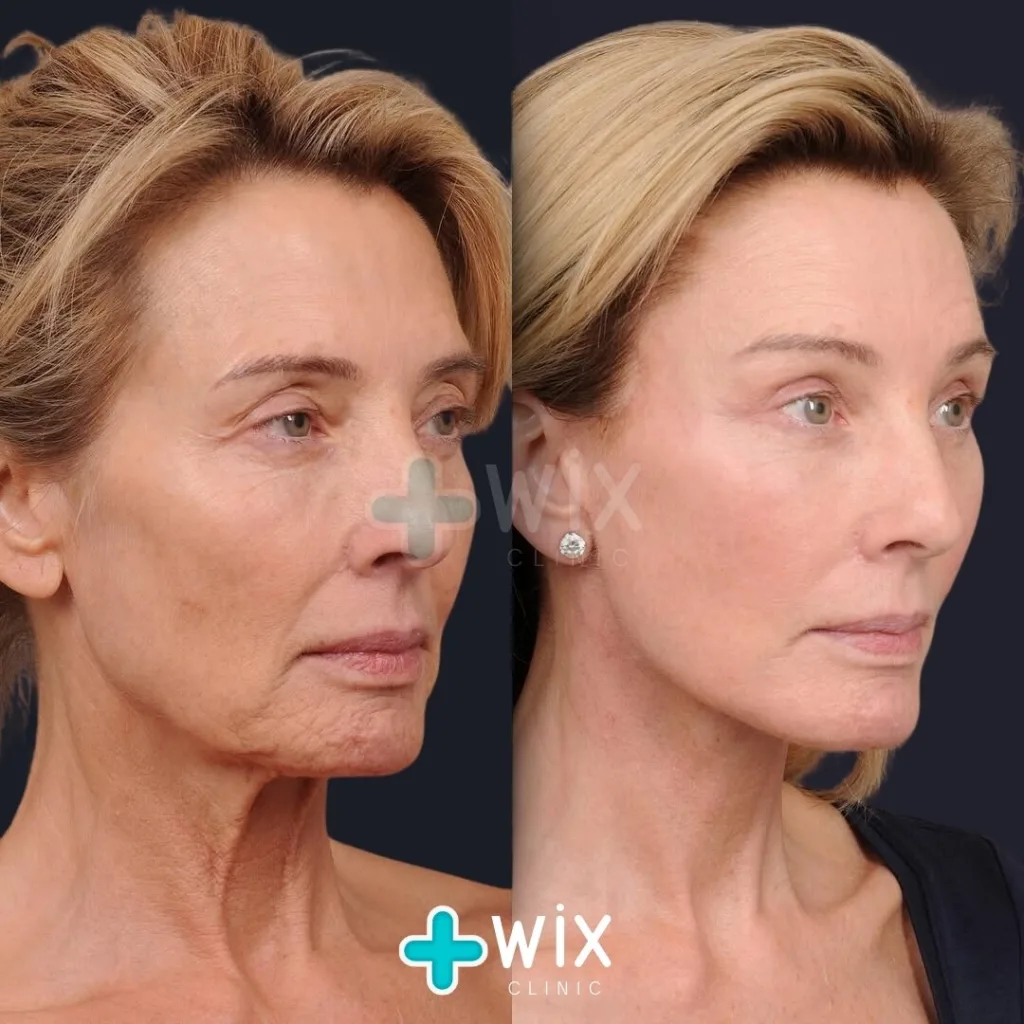 mini facelift before and after