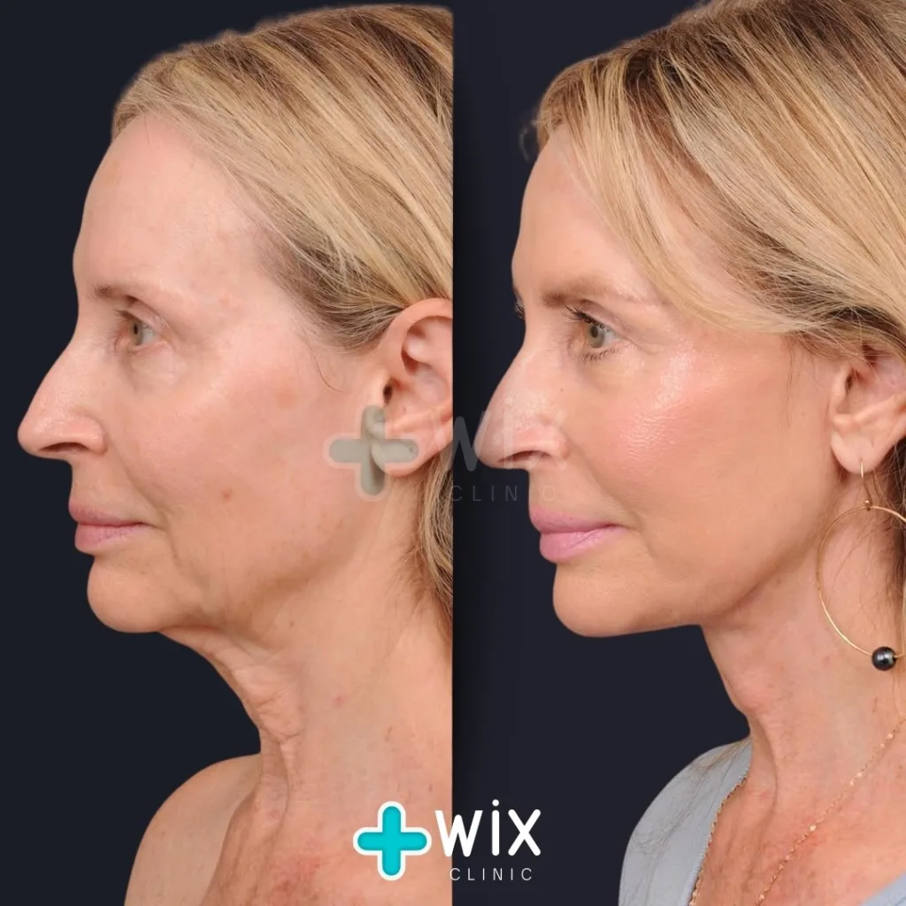 Facelift before and after