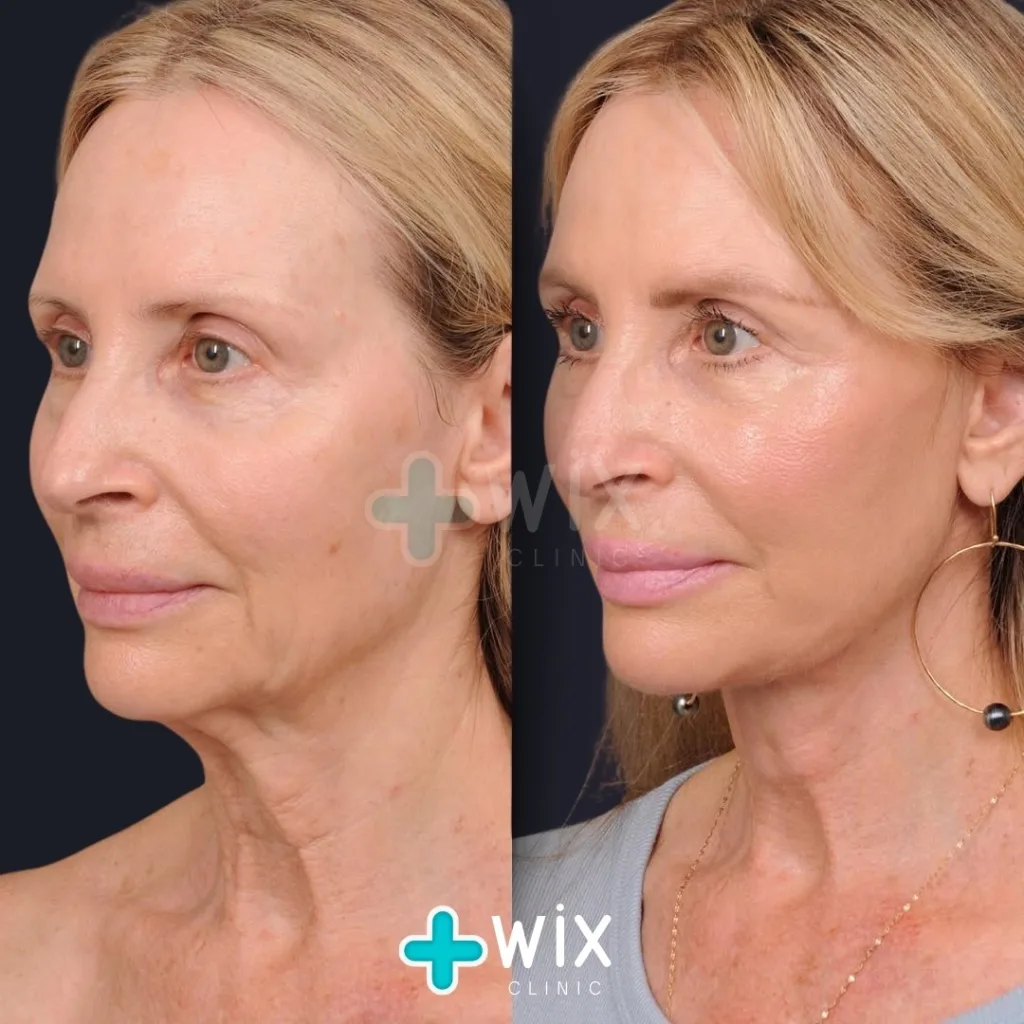 Facelift before and after