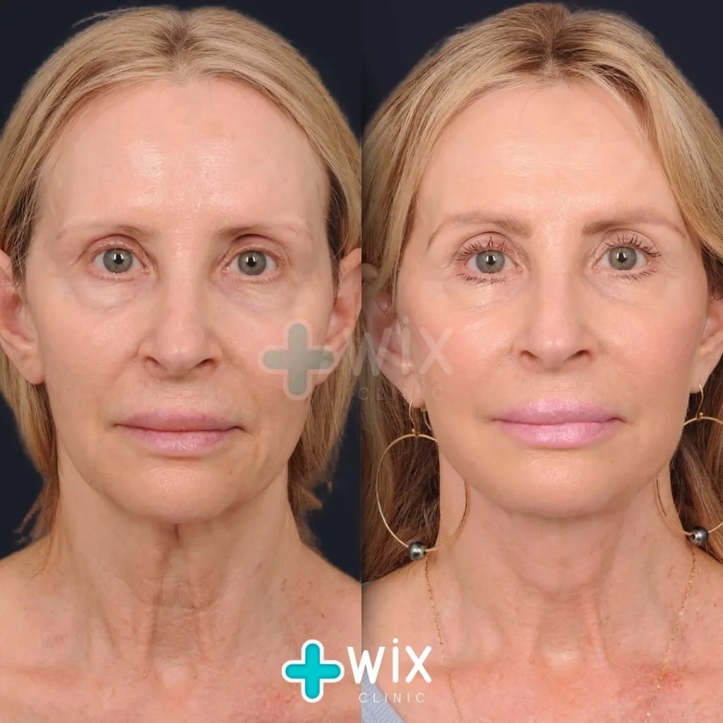 Facelift before and after