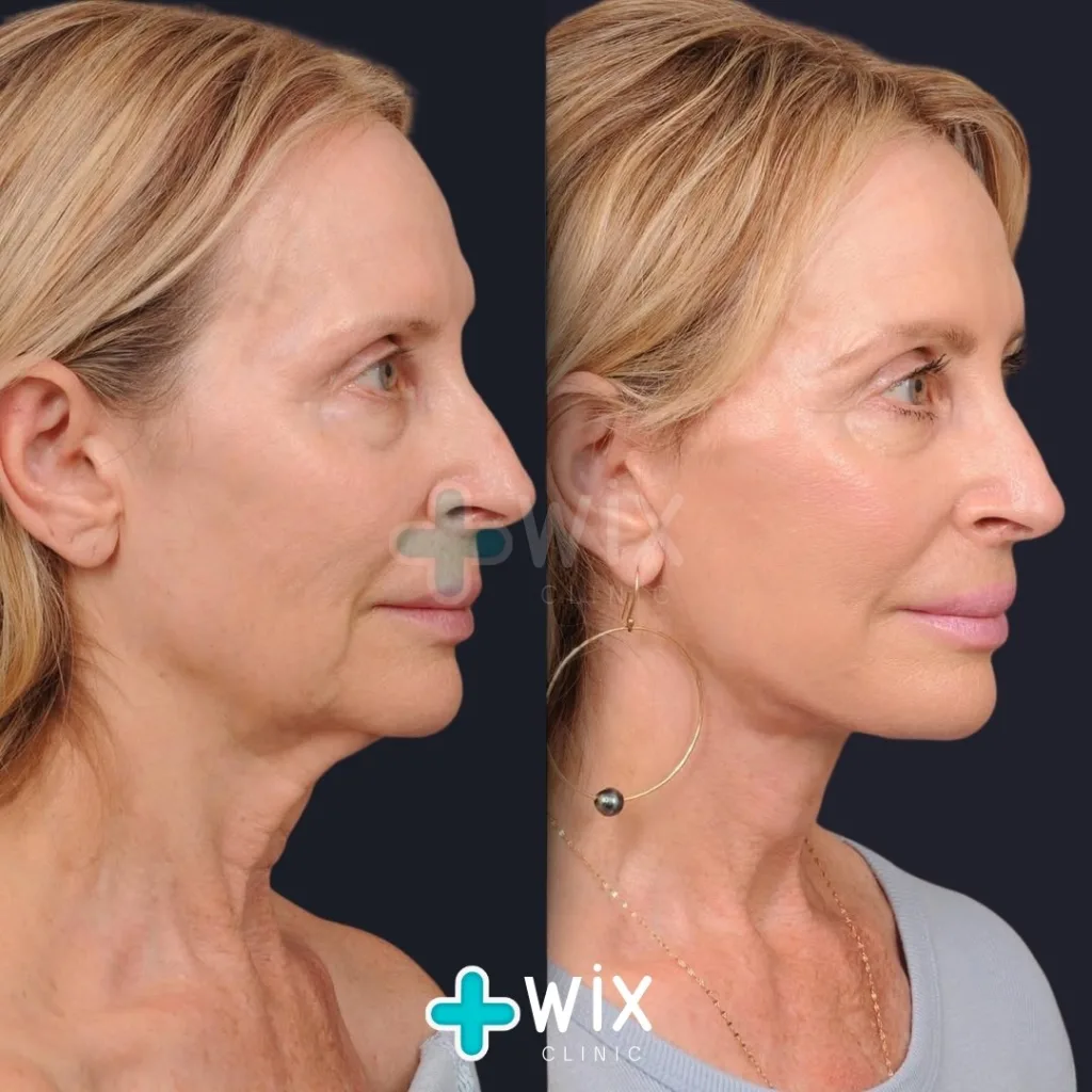 Facelift before and after