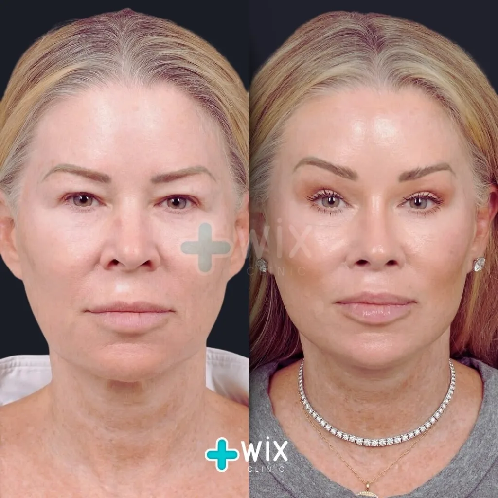 Facelift before and after