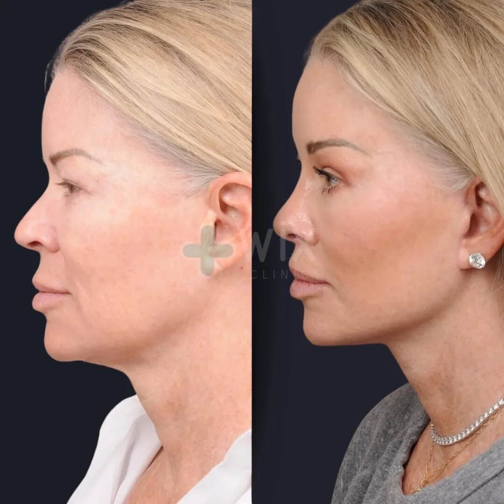 Facelift before and after