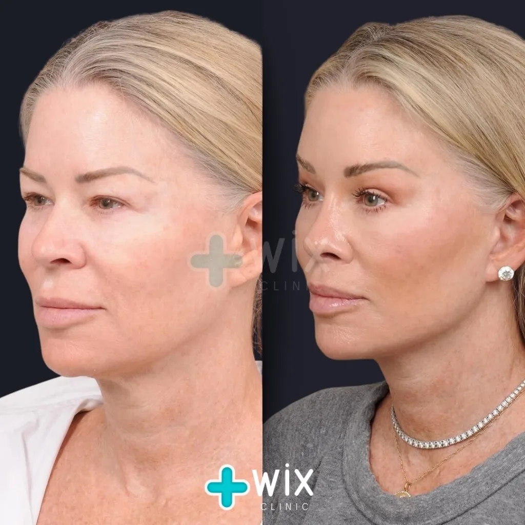 Facelift before and after