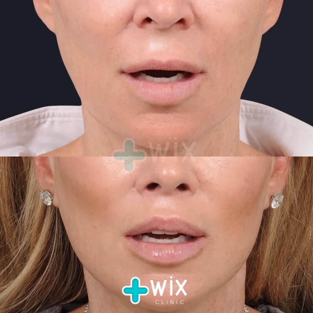 Facelift before and after